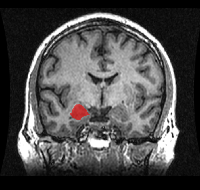 By Amber Rieder Jenna Traynor Geoffrey B Hall Own work CC0 via Wikimedia Commons MRI Location Amygdala up