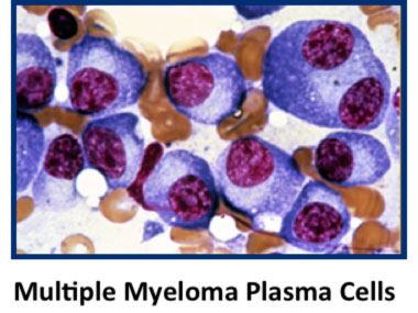 Multiple Myeloma plasma